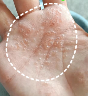 夏季高发汗疱疹引关注 专家辟谣：无传染性 科学防护可有效预防